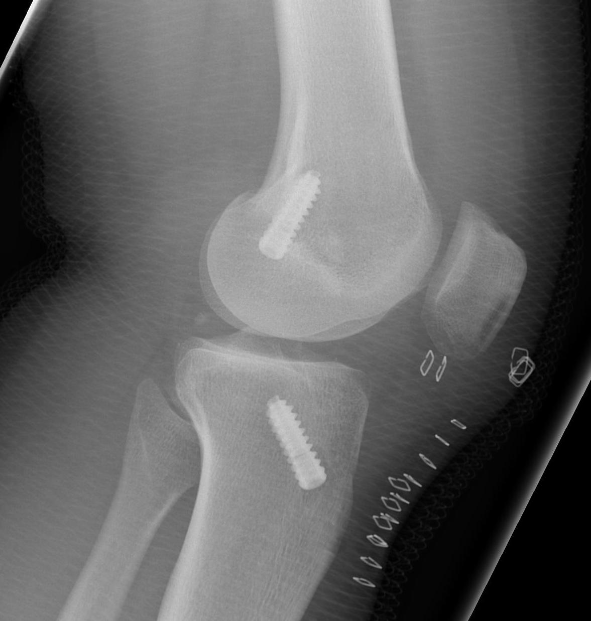 ACL BPTB Autograft Lateral